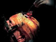 lm brain surgery george fracchiaa - ... ...